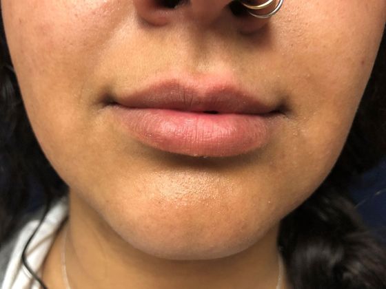 Cosmetic Injectables & Fillers*: Case 7 Lip Filler - Before