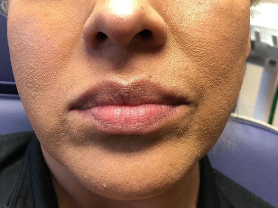 Cosmetic Injectables & Fillers*: Case 6 Lip Filler - Before