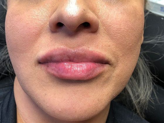 Cosmetic Injectables & Fillers*: Case 6 Lip Filler - After