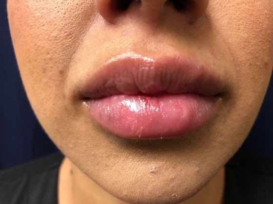 Cosmetic Injectables & Fillers*: Case 5 Lip Filler - After