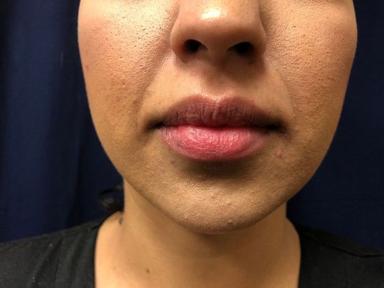 Cosmetic Injectables & Fillers*: Case 5 Lip Filler - Before
