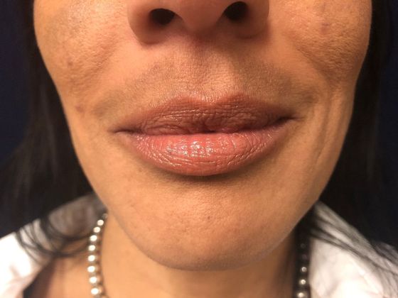 Cosmetic Injectables & Fillers*: Case 37 Lip Filler - Before