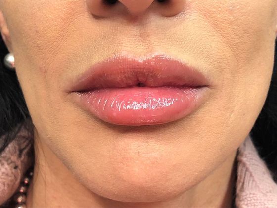 Cosmetic Injectables & Fillers*: Case 37 Lip Filler - After