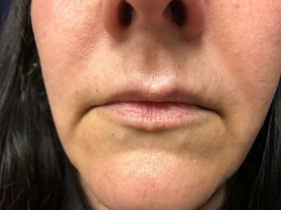 Cosmetic Injectables & Fillers*: Case 4 Lip Filler - Before