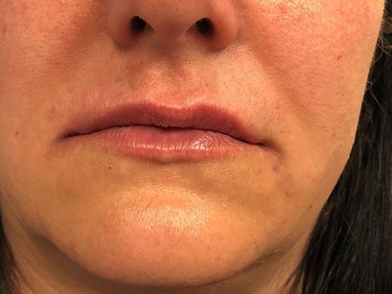 Cosmetic Injectables & Fillers*: Case 4 Lip Filler - After