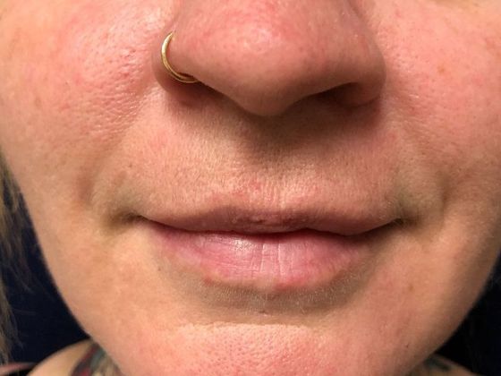Cosmetic Injectables & Fillers*: Case 3 Lip filler - Before