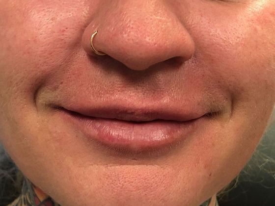 Cosmetic Injectables & Fillers*: Case 3 Lip filler - After