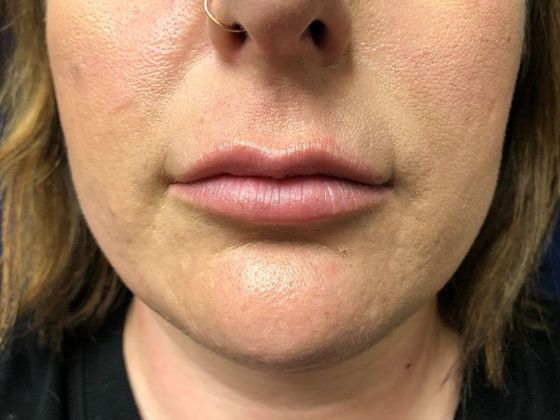 Cosmetic Injectables & Fillers*: Case 2 Lip Filler - Before