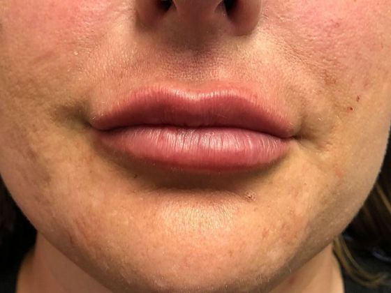 Cosmetic Injectables & Fillers*: Case 2 Lip Filler - After