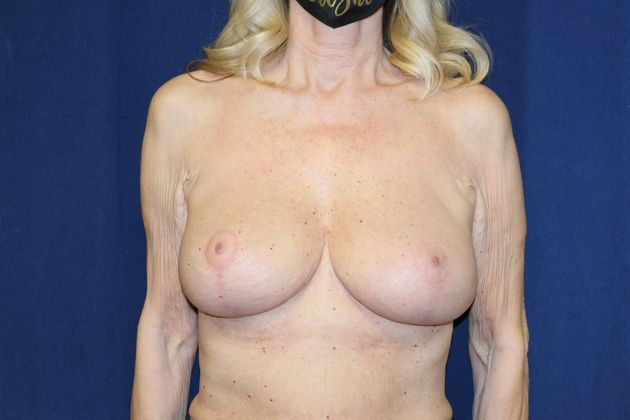 Breast Implant Removal and Exchange: Case 13 - After