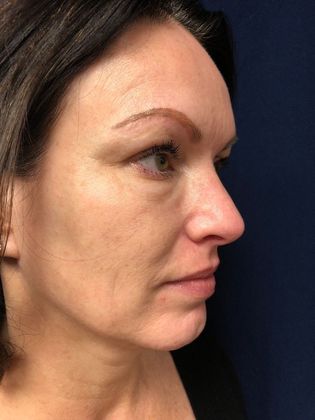 Potenza RF Microneedling : Case 2 - Before
