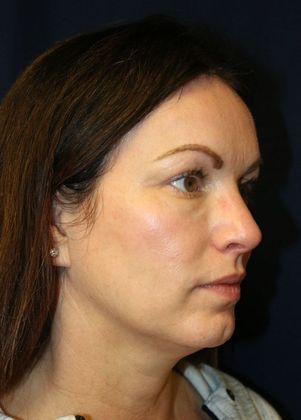 Potenza RF Microneedling : Case 2 - After