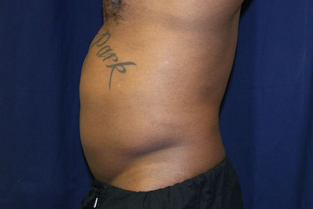Abdominal Etching : Case 1 - Before Lipo