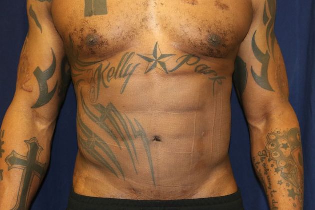 Abdominal Etching : Case 1 - After Abdominal Etching
