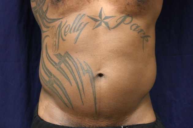 Liposuction & Safe Lipo: Case 44 - Before