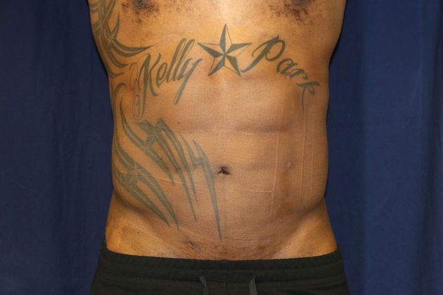 Liposuction & Safe Lipo: Case 44 - After