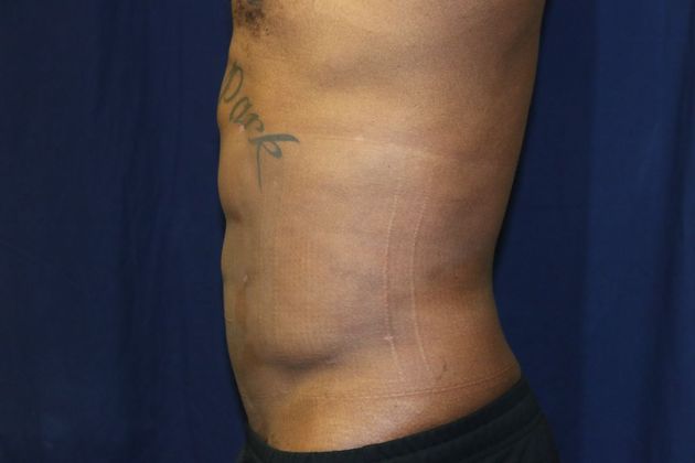 Liposuction & Safe Lipo: Case 44 - After