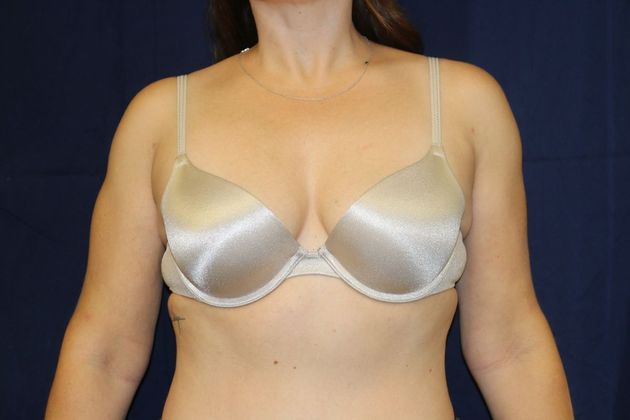 Arm Lift*/Arm Sculpting: Case 11 - After