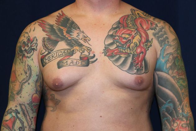 Male Breast Reduction*: Case 6 - Before