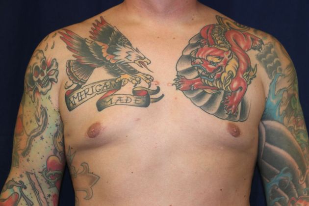Male Breast Reduction*: Case 6 - After