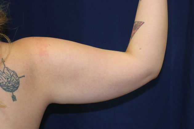 Arm Lift*/Arm Sculpting: Case 12 - Before