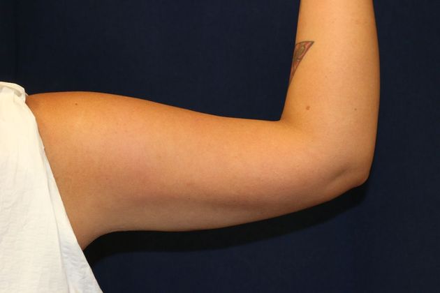 Arm Lift*/Arm Sculpting: Case 12 - After