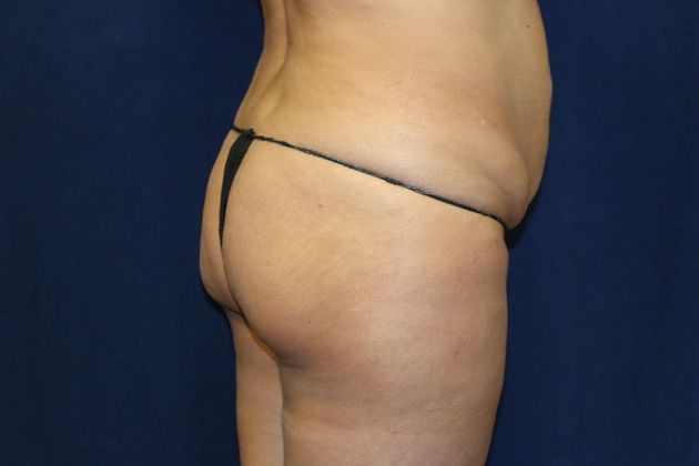 Brazilian Butt Lift : Case 3 - Before