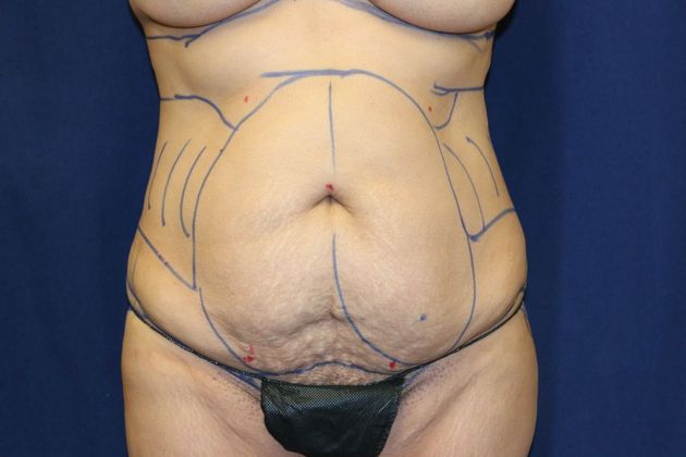 Brazilian Butt Lift : Case 3 - Before