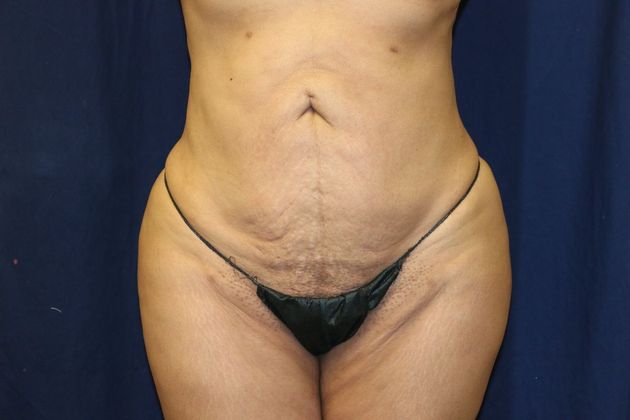 Brazilian Butt Lift : Case 3 - After