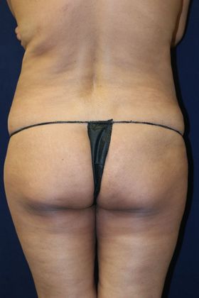 Brazilian Butt Lift : Case 3 - Before
