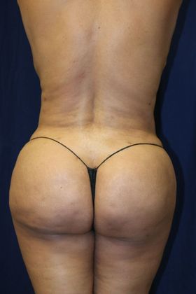 Brazilian Butt Lift : Case 3 - After