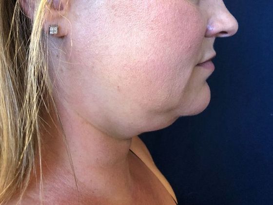 KYBELLA™ *: Kybella 1 - Before