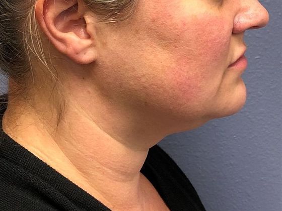 KYBELLA™ *: Kybella 1 - After