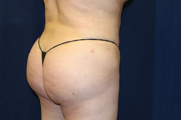 Brazilian Butt Lift : Case 8 - After