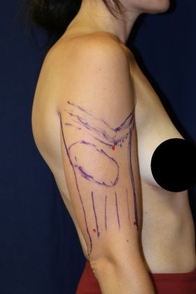 Arm Lift*/Arm Sculpting: Case 13 - Before