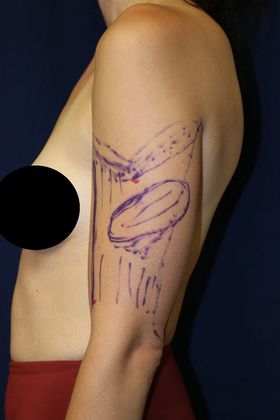 Arm Lift*/Arm Sculpting: Case 13 - Before