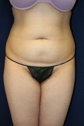 Brazilian Butt Lift : Case 11 - Before