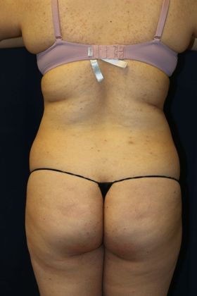 Brazilian Butt Lift : Case 11 - Before