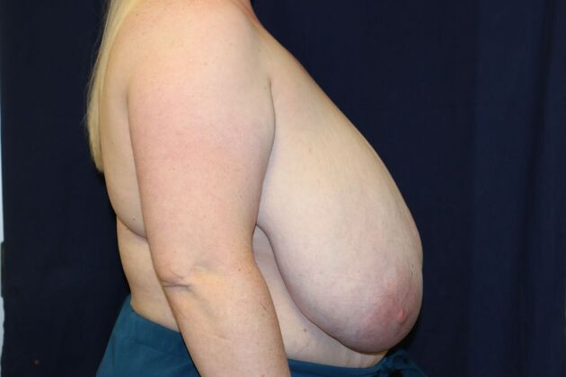 Breast Reduction*: Case 11 - Before