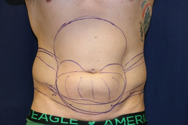 Liposuction & Safe Lipo: Case - Before