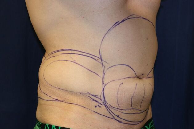 Liposuction & Safe Lipo: Case - Before