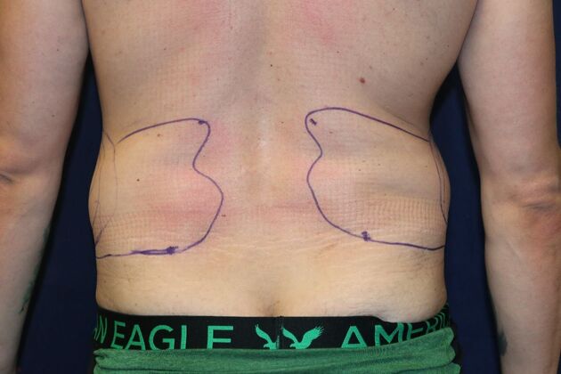 Liposuction & Safe Lipo: Case - Before