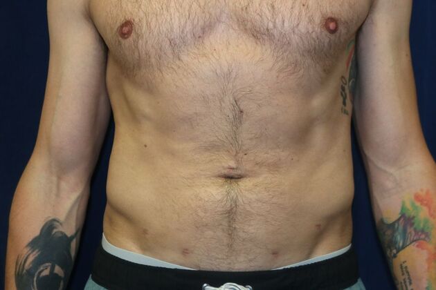 Liposuction & Safe Lipo: Case - After