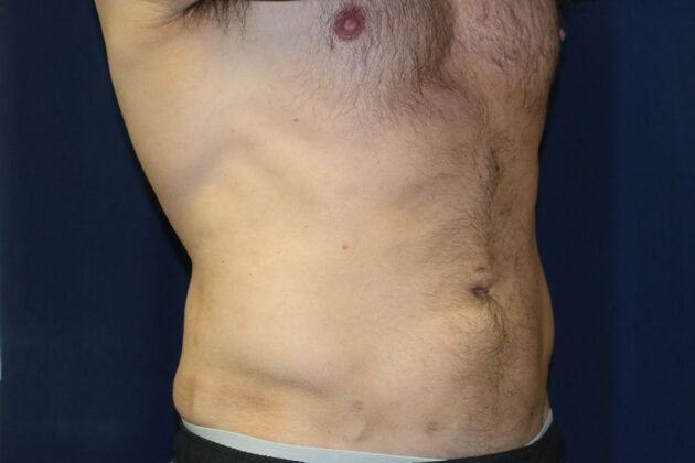 Liposuction & Safe Lipo: Case - After