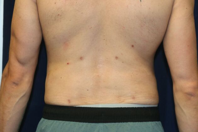 Liposuction & Safe Lipo: Case - After