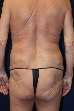 Brazilian Butt Lift : Case 14 - Before