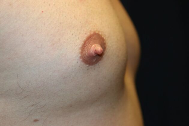 Male Breast Reduction*: Case 8 - Before