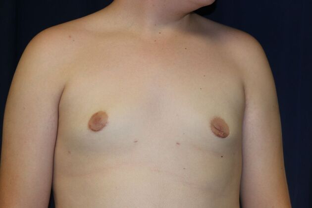 Male Breast Reduction*: Case 9 - After