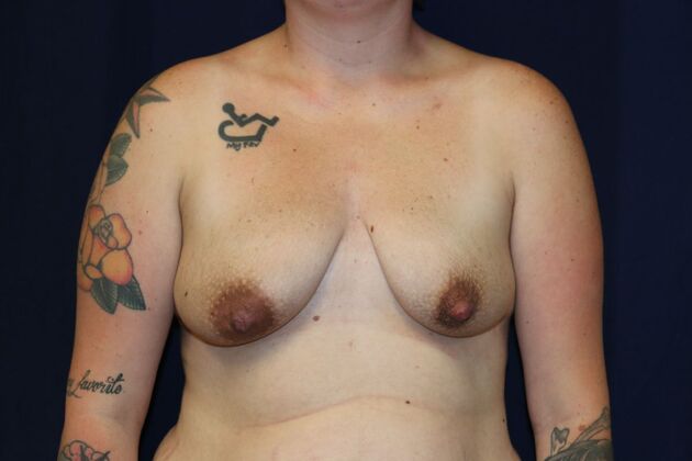Breast Lift With Augmentation*: Case 17 - Before