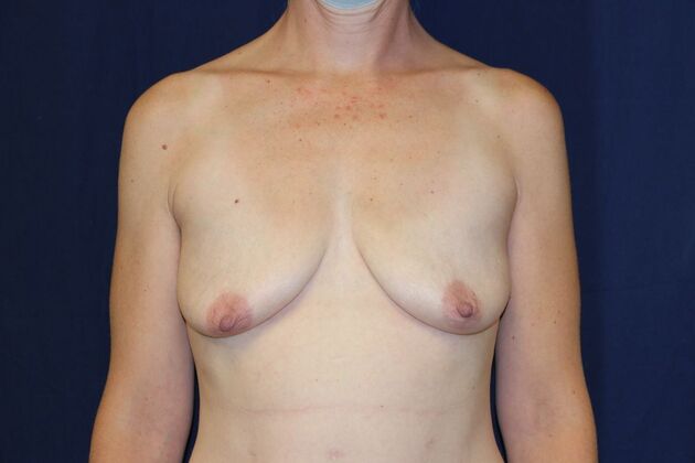 Breast Lift With Augmentation*: Case 22 - Before